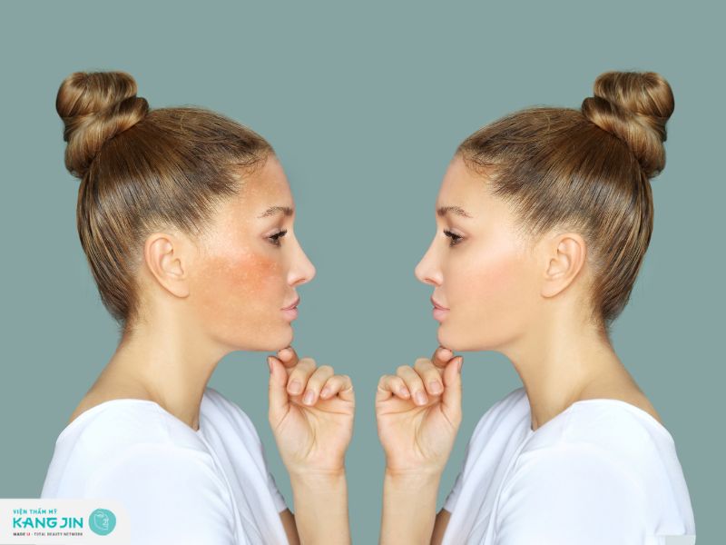 kích trắng da là gì?