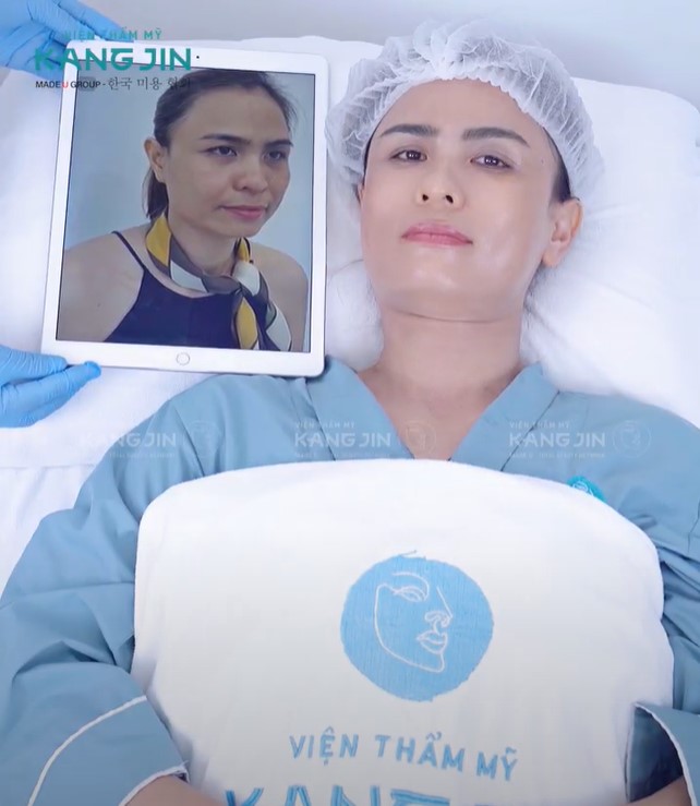 Làn da cải thiện rõ rệt ngay sau khi thực hiện liệu trình KangJin Maxcollagen Diamond Siêu Vi Điểm