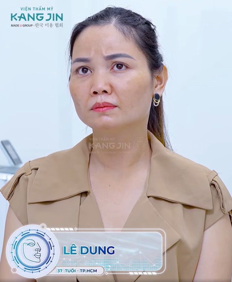 Làn da lão hóa rõ rệt của chị Dung trước khi thực hiện trẻ hóa 