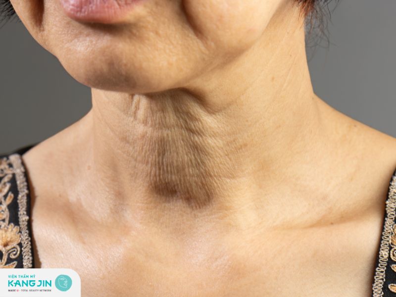 Ngăn ngừa nếp nhăn ở cổ