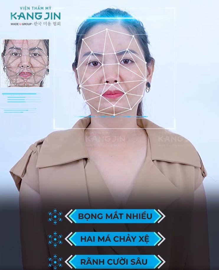 Tình trạng da của chị Dung với nhiều khuyết điểm sau khi soi da 