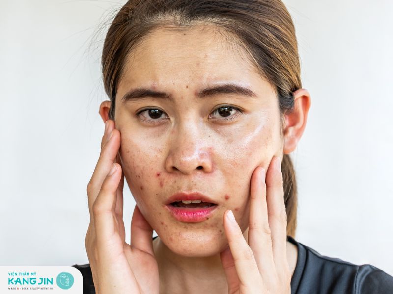 Tinh dầu tràm trà giúp cải thiện tình trạng da dầu