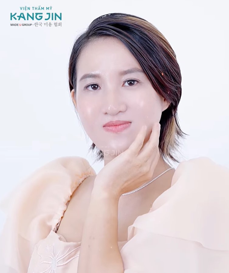 Viện thẩm mỹ KangJin thành công thay đổi nhan sắc cho chị Út Lan 