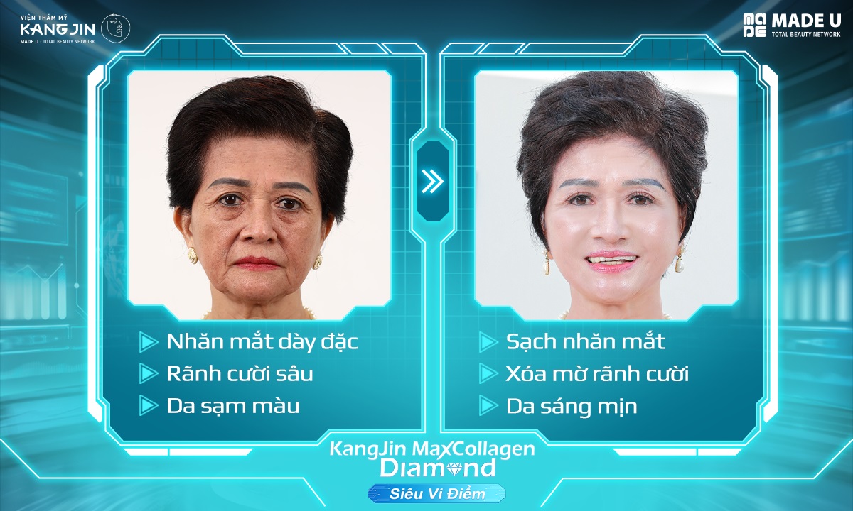 ảnh cô Mai sau khi thực hiện trẻ hóa da