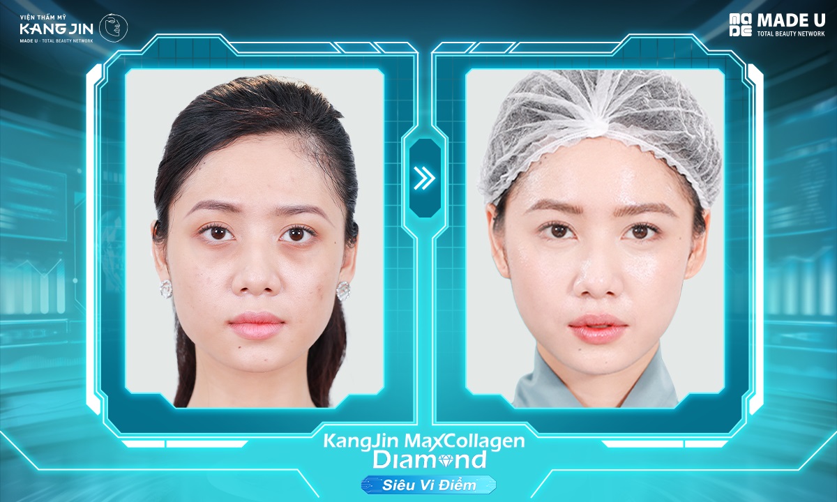 Làn da khách hàng Thu Phương sau điều trị