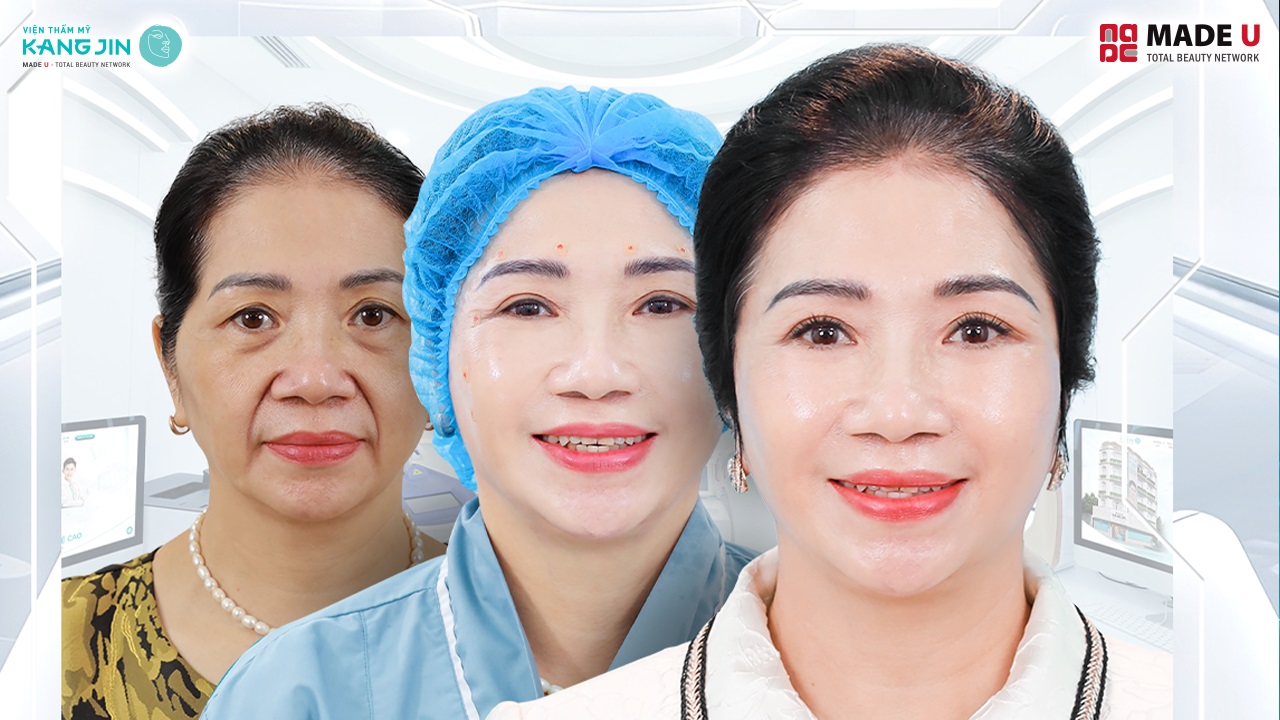 Tình trạng da của cô Kim Yến sau 3 tháng
