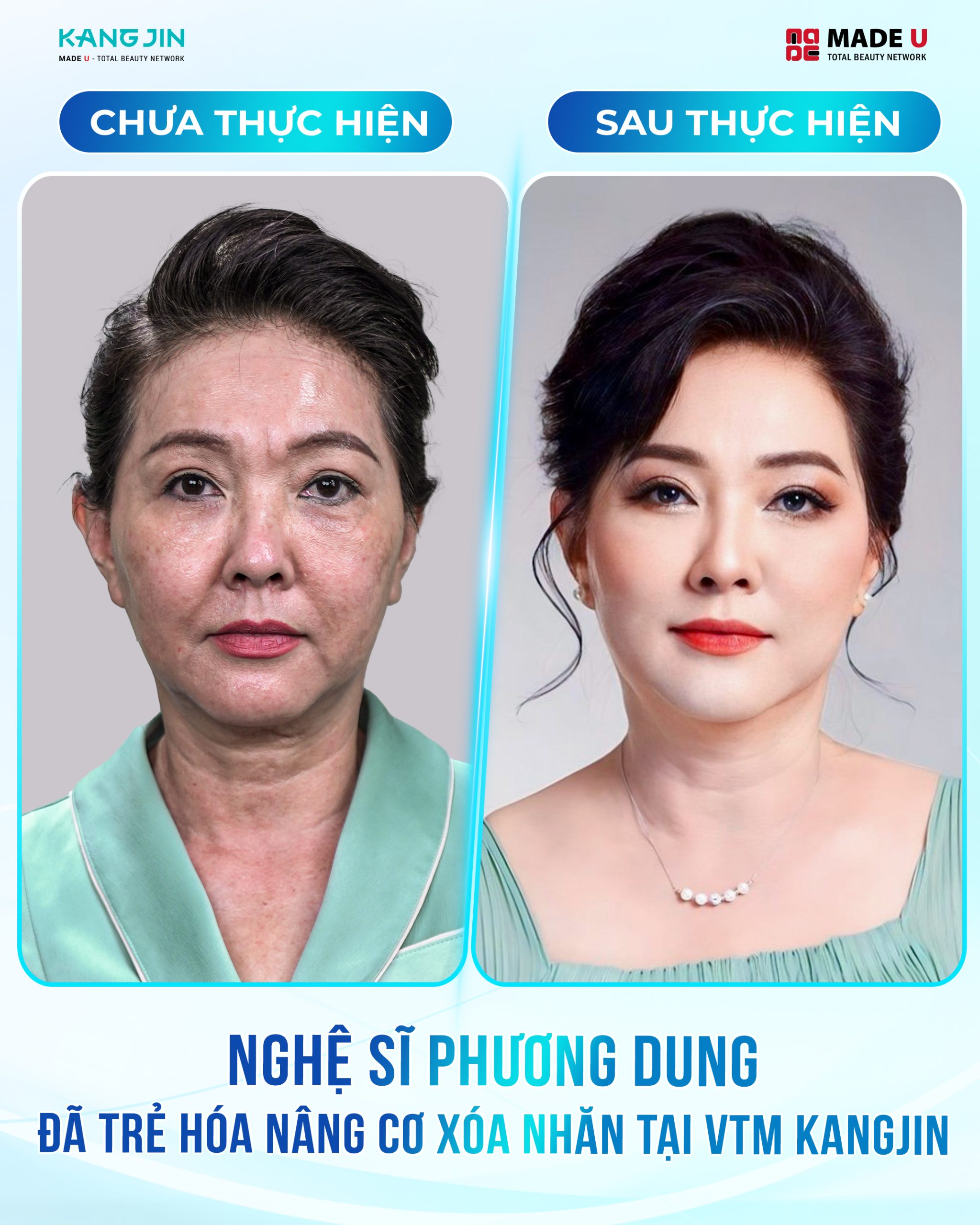 xóa nếp nhăn