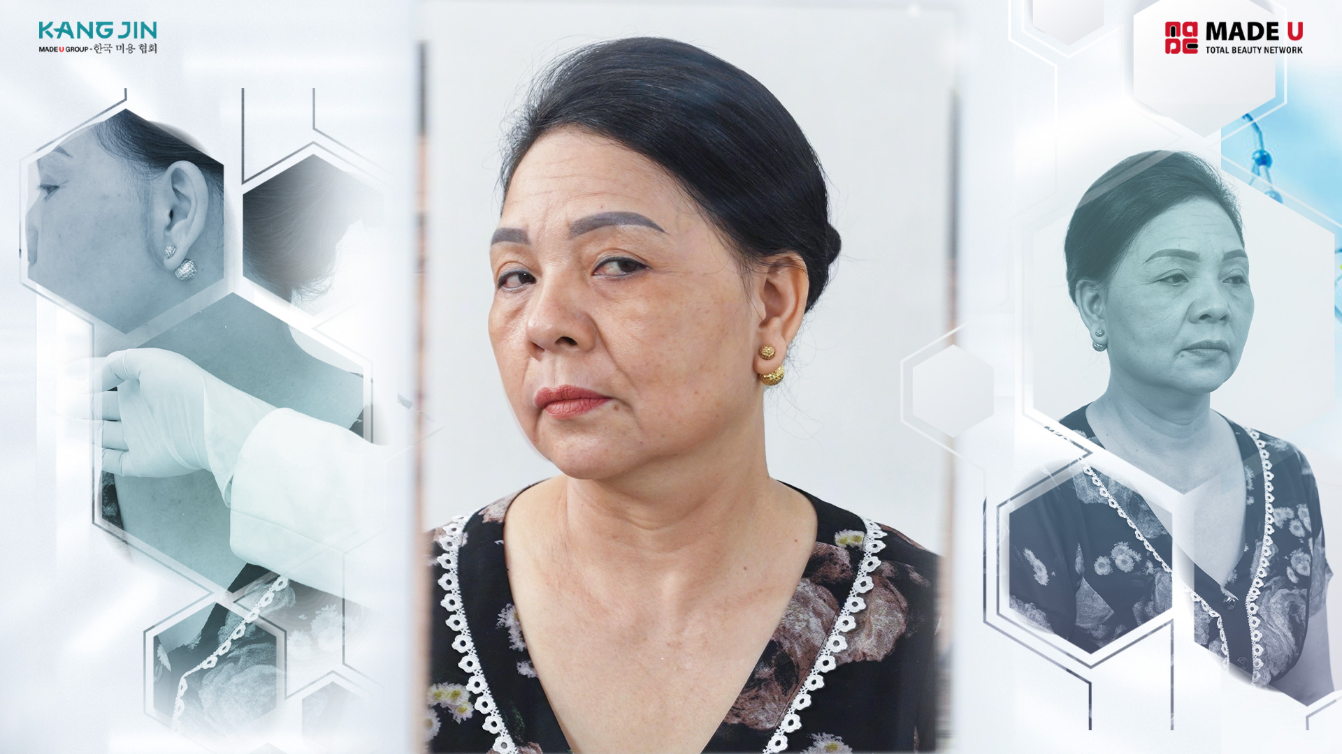 Dù đã can thiệp dao kéo nhưng làn da vẫn chảy xệ trở lại