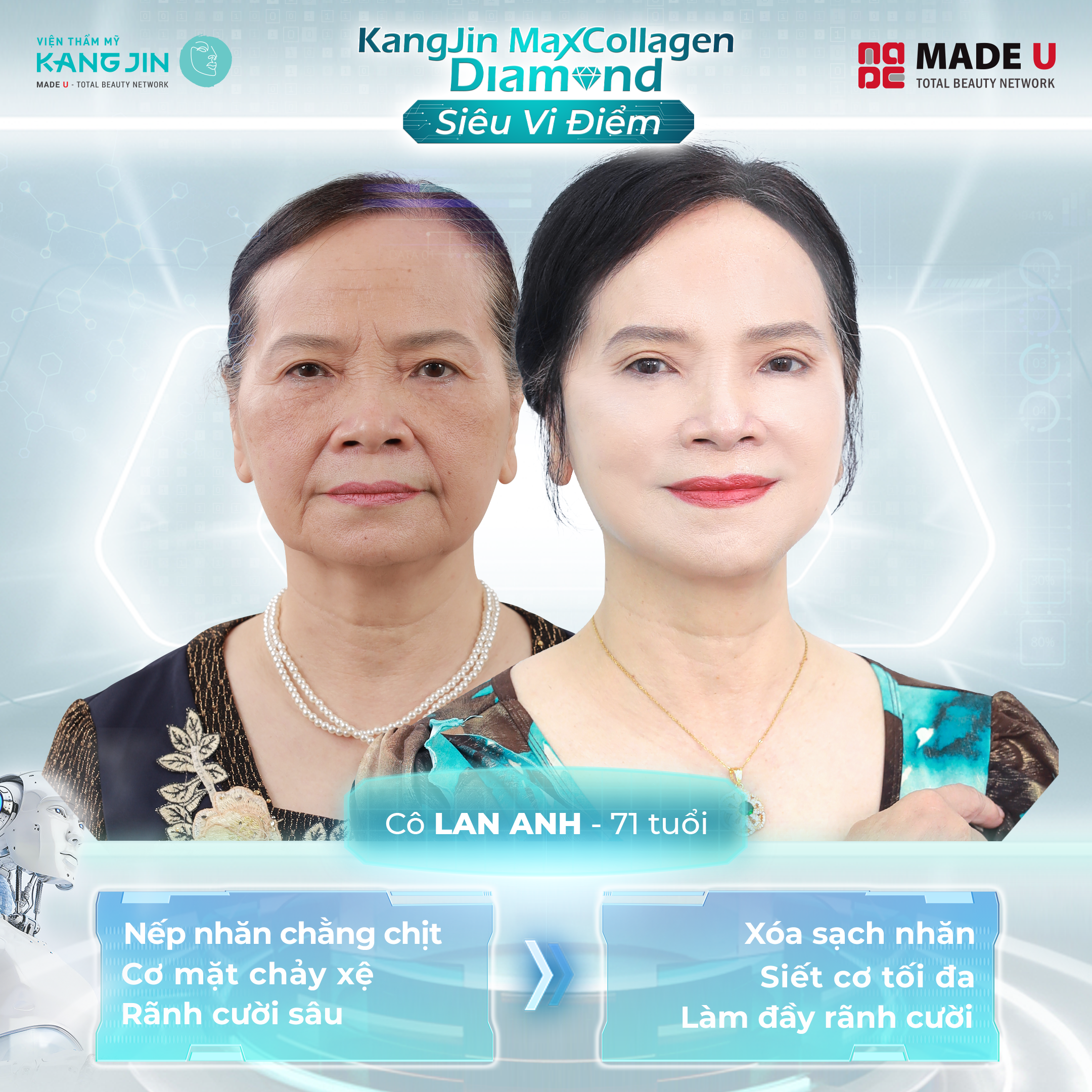 Khách hàng thực hiện trẻ hóa xóa rãnh cười tại Viện thẩm mỹ KangJin