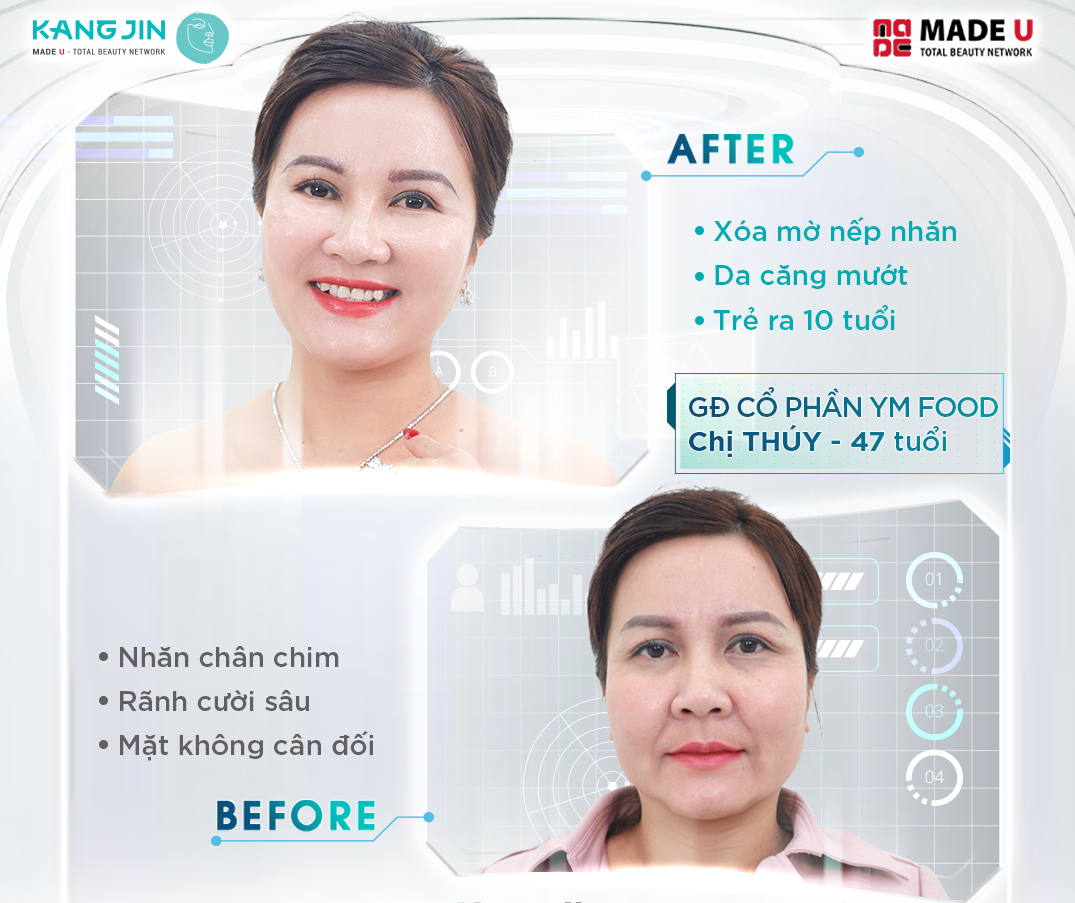 Hình ảnh một số khách hàng trẻ hóa da thành công tại Viện thẩm mỹ KangJin 