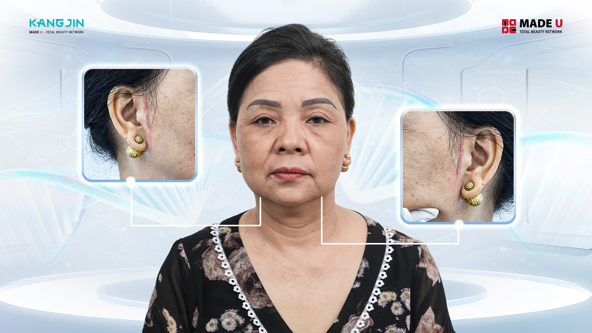 Vết sẹo di chứng hậu phẫu thuật căng da đã làm chị mất niềm tin vào thẩm mỹ