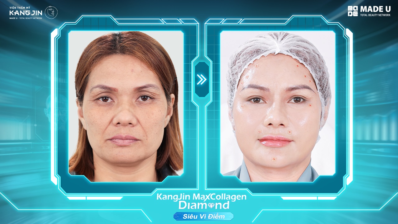 da của chị Hiền sau điều trị