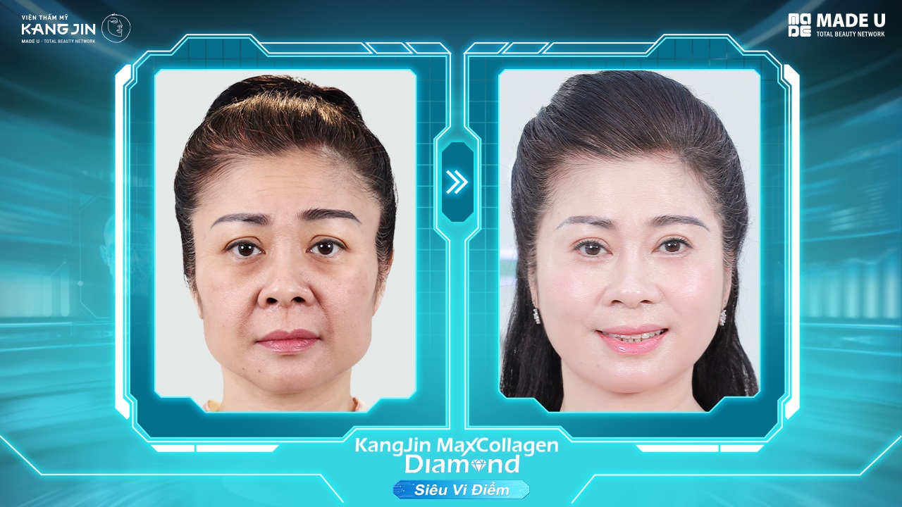 Tình trạng da của chị Lan Hương sau điều trị