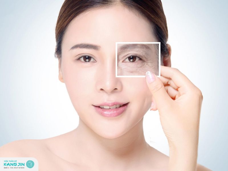 chi phí xóa nếp nhăn ở mắt