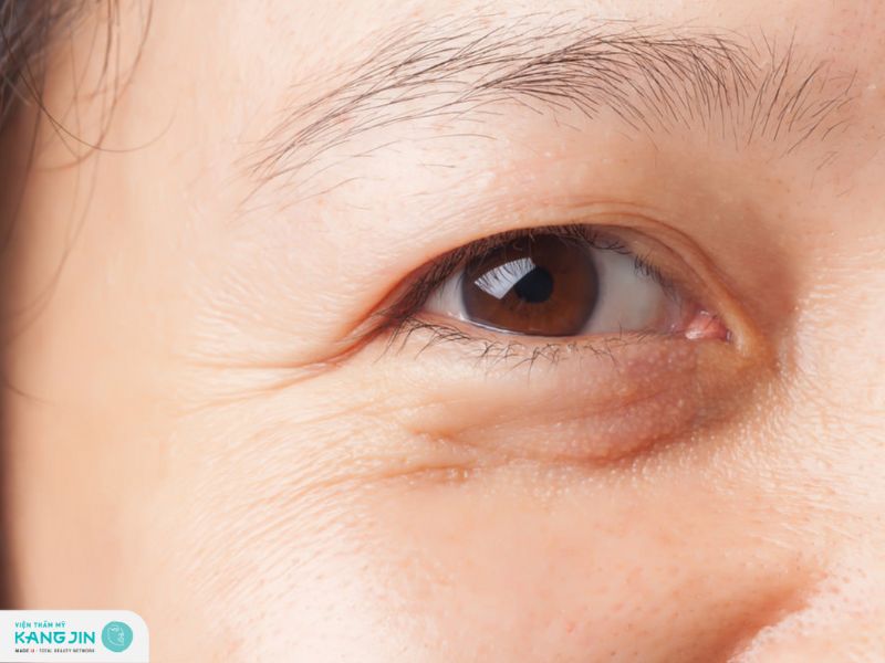 chi phí xóa nếp nhăn ở mắt