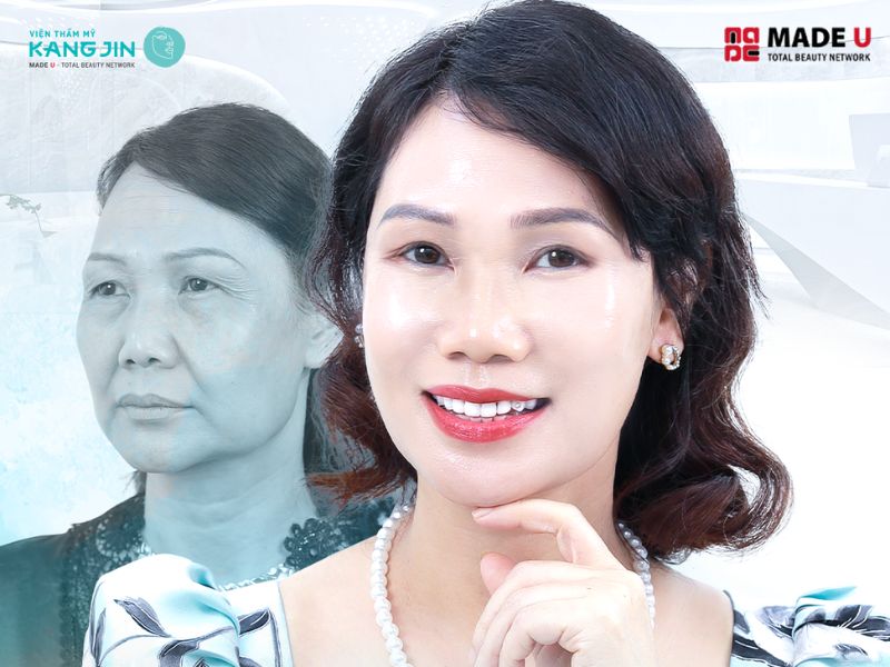 chi phí xóa nếp nhăn khóe miệng