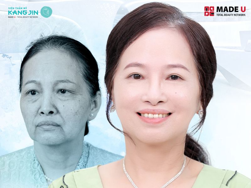 chi phí xóa nếp nhăn khóe miệng