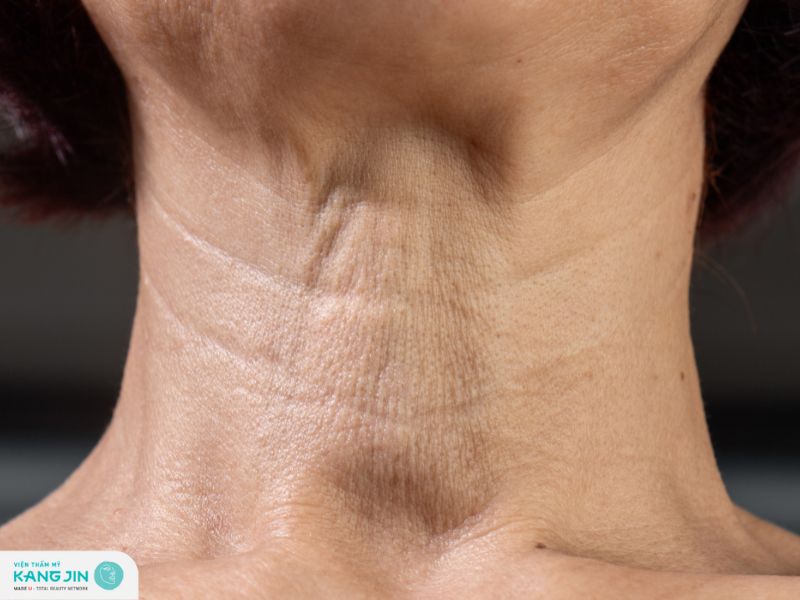 giá xóa nếp nhăn ở cổ