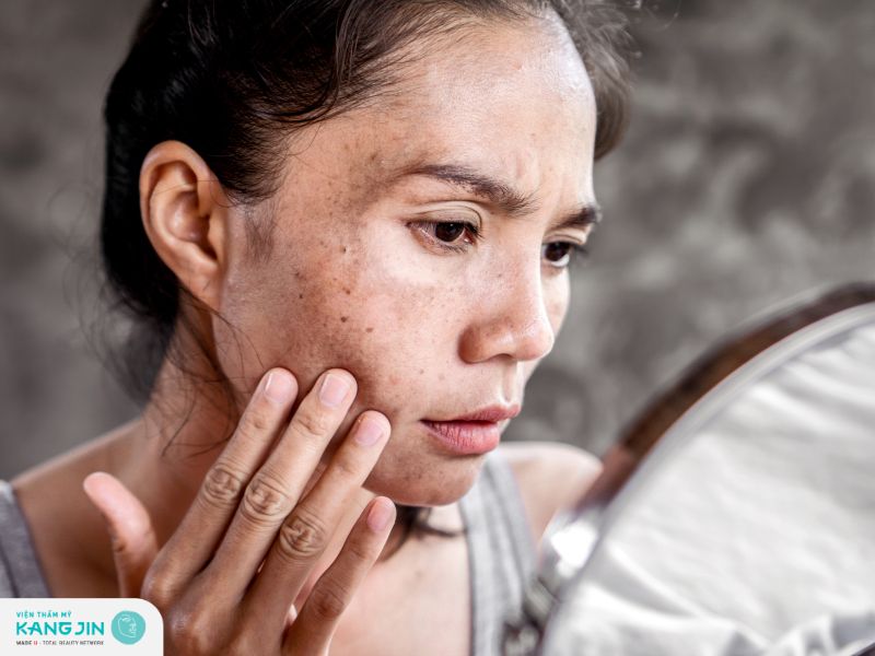 Da bị nám sạm nếu thực hiện căng chỉ collagen không uy tín 