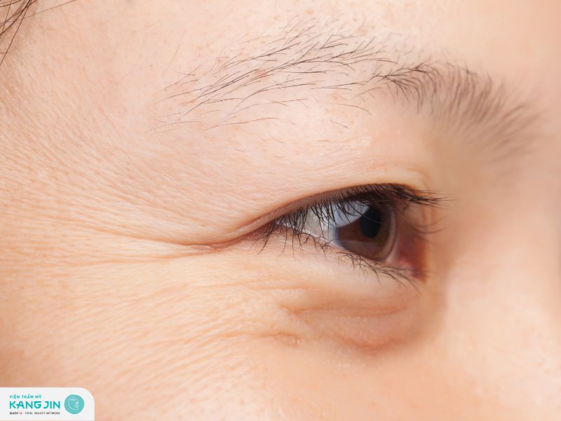 nếp nhăn ở mắt