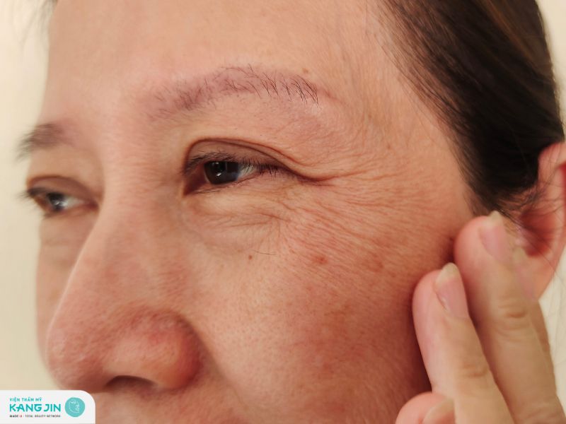 nếp nhăn ở mắt