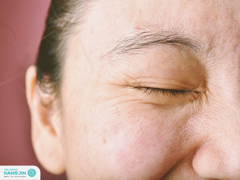 nếp nhăn ở mắt