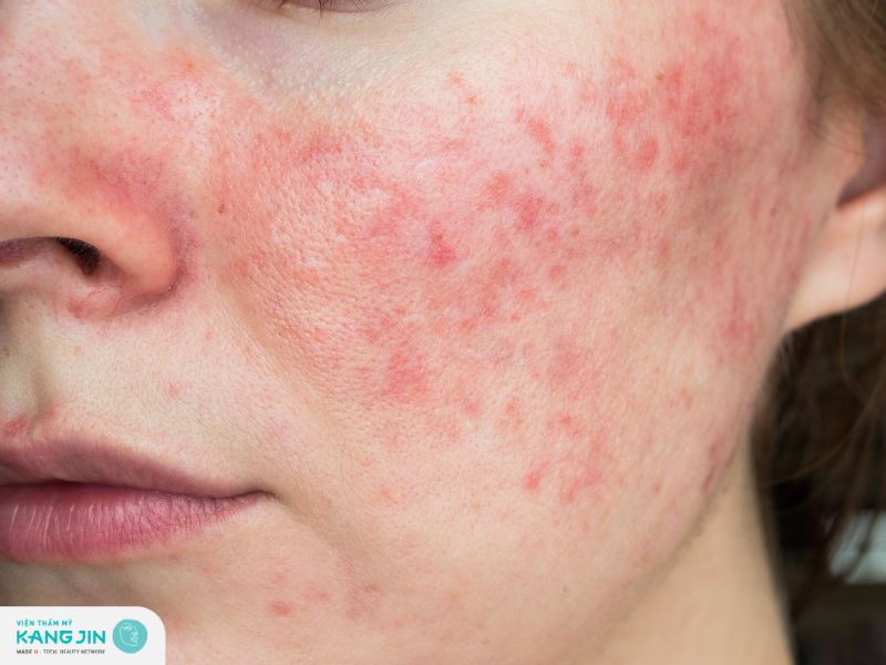 Da bị kích ứng sau khi thực hiện nâng cơ mặt bằng chỉ 