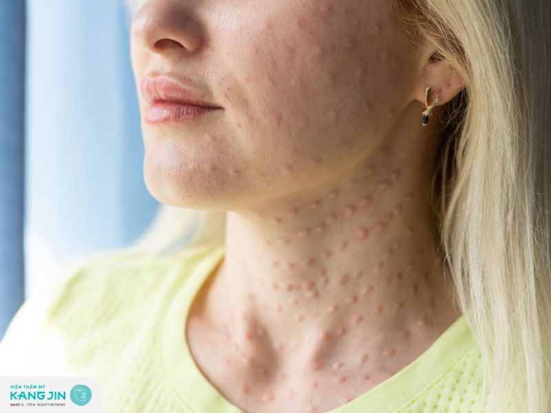 Da bị sưng sau khi thực hiện căng chỉ collagen 