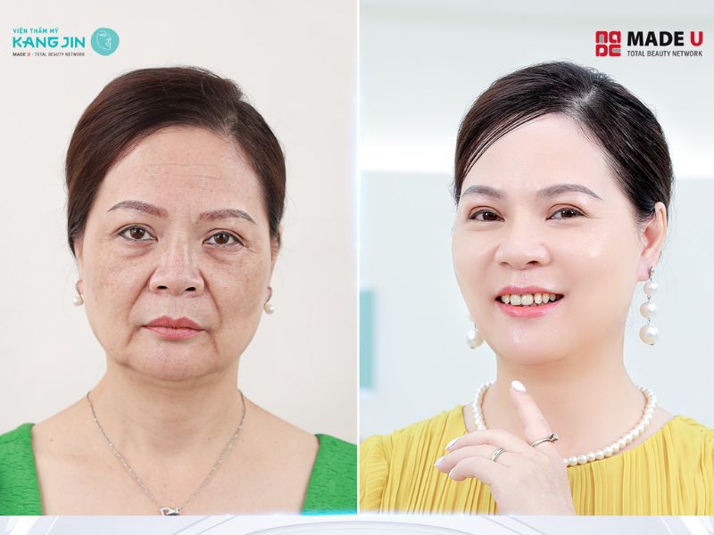 Chị Thu Hằng tự tin và rạng rỡ với nhan sắc trẻ trung sau khi trẻ hóa da tại Sejung