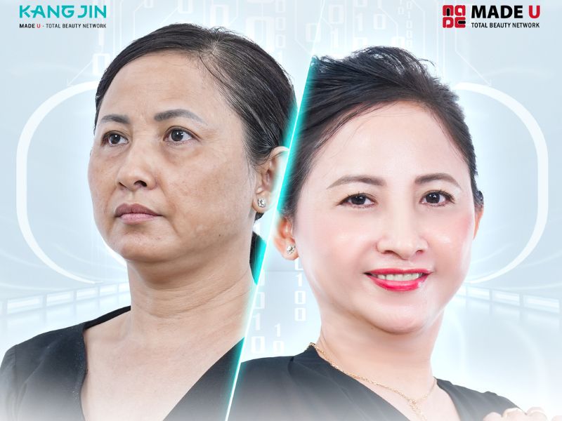 Khám phá các phương pháp xóa nếp nhăn khóe miệng trẻ hóa gương mặt