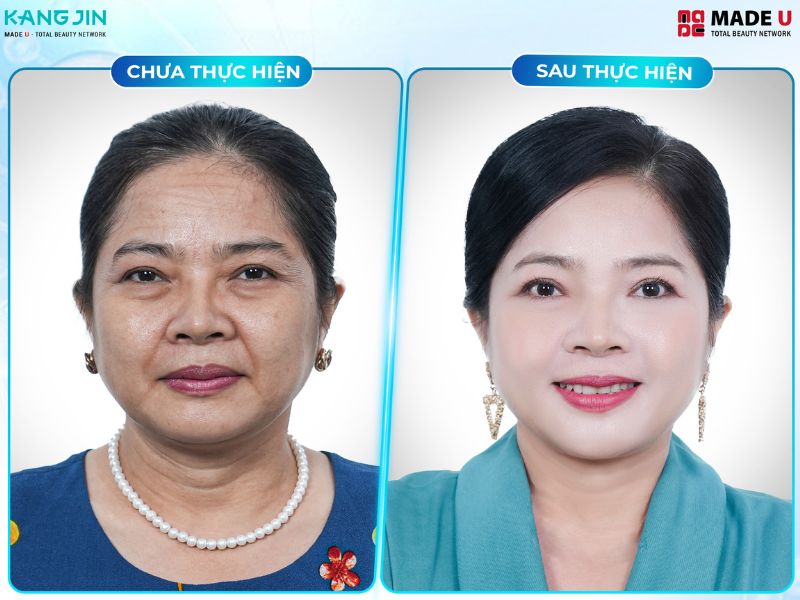 xóa nếp nhăn trên mặt