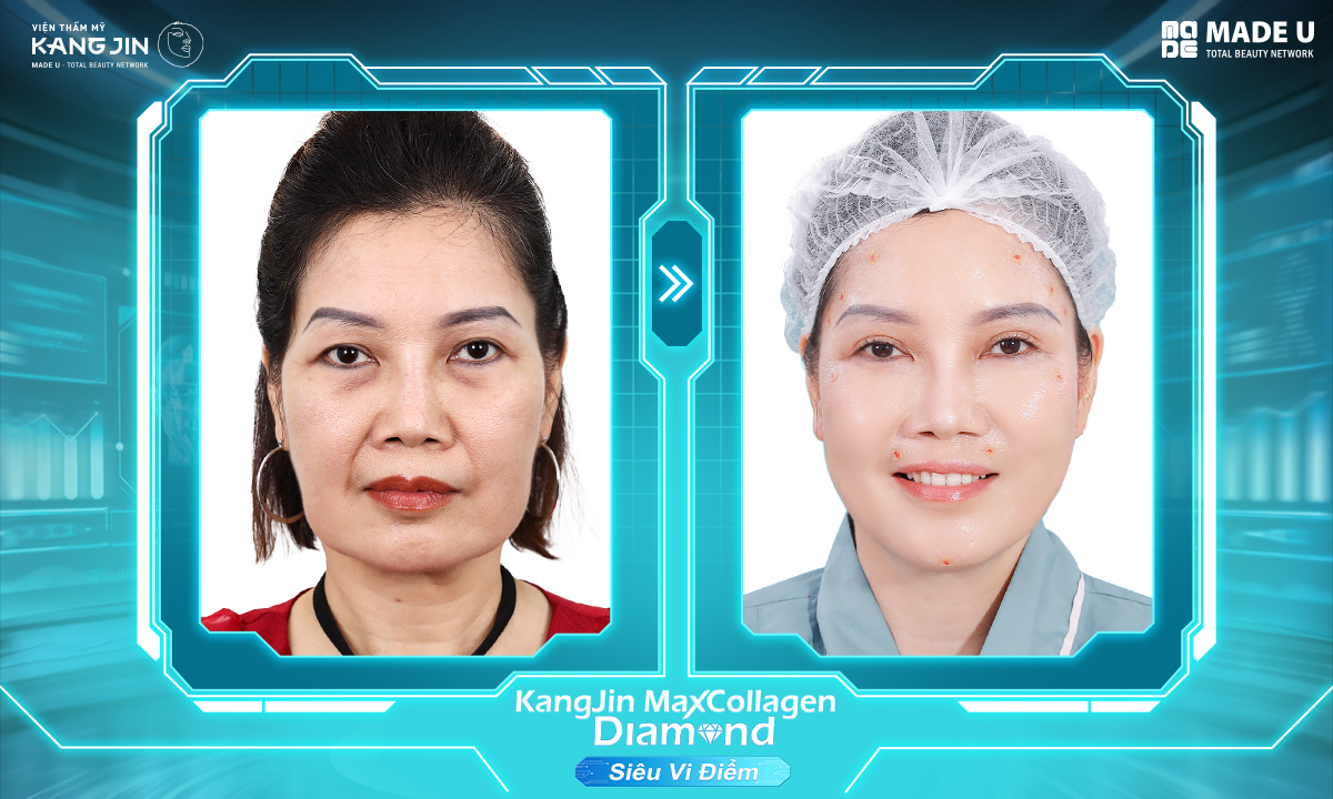 Tình trạng da của chị Anna sau liệu trình