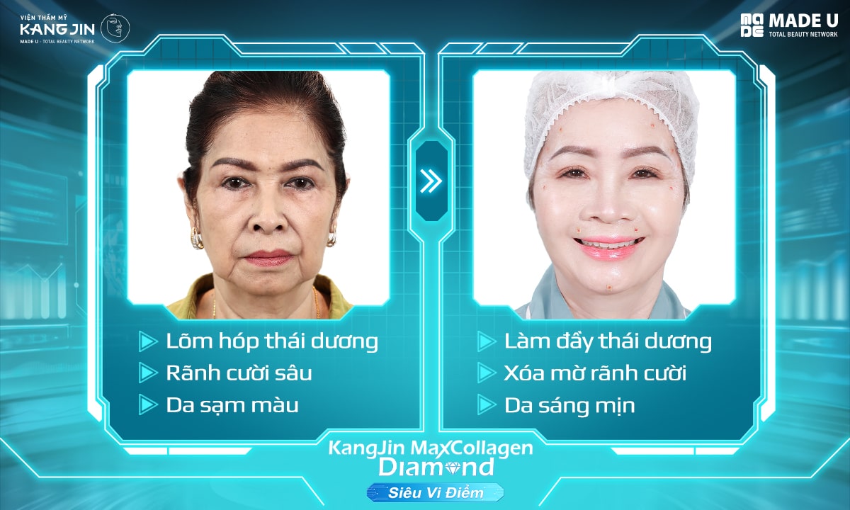 sau liệu trình, làn da cô Chinh đã cải thiện gần hết các dấu hiệu lão hóa