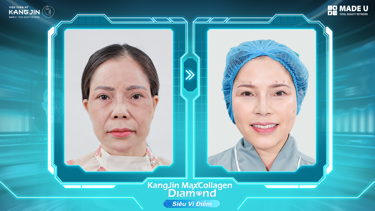 làn da chị Hoa sau liệu trình