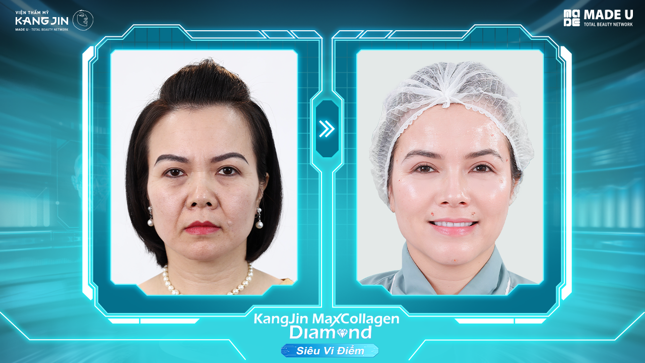 tình trạng da của chị Emma ngay sau kết thúc liệu trình