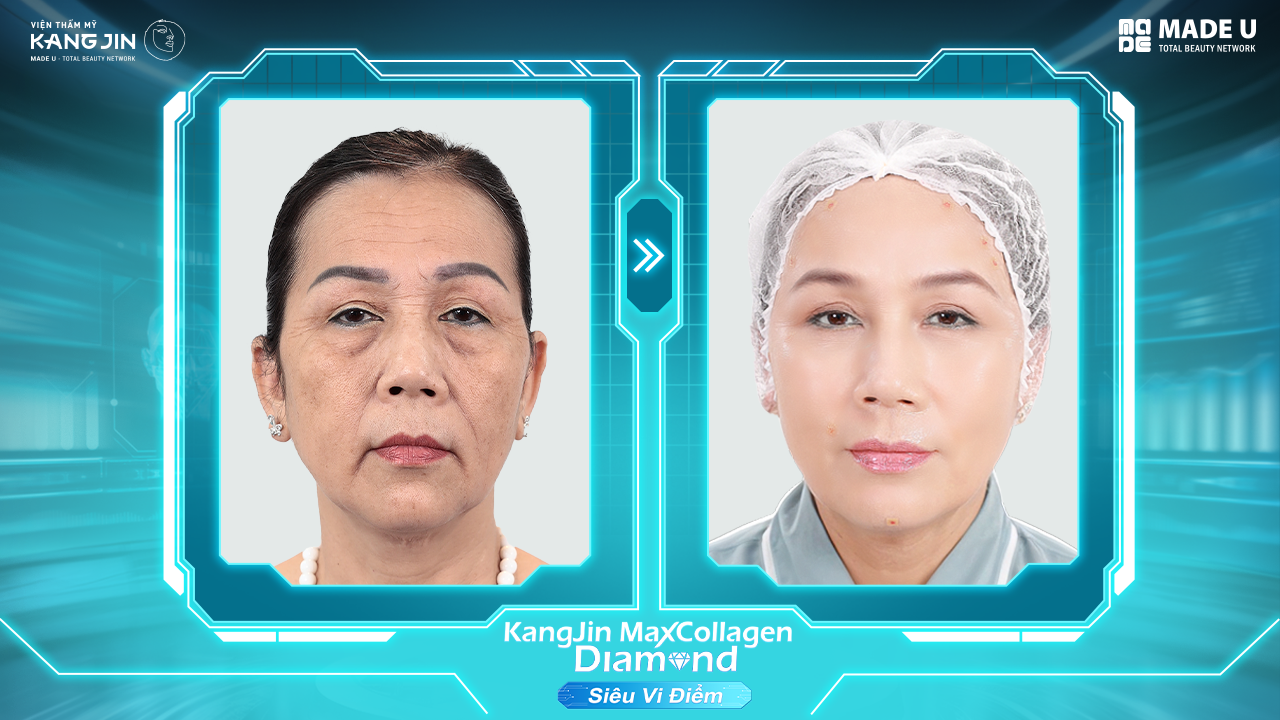 da cô Trâm sau điều trị