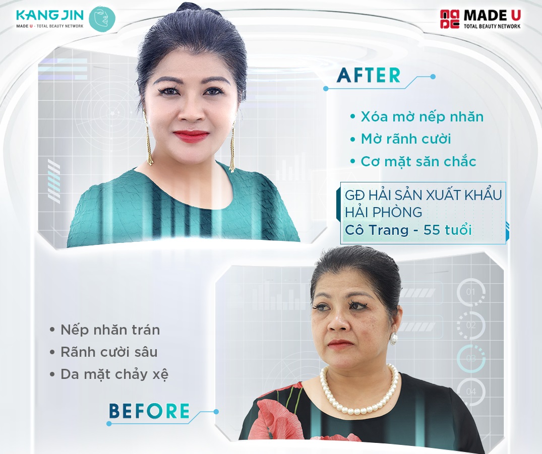 Làn da của khách hàng thay đổi rõ rệt sau khi thực hiện trẻ hóa bằng KangJin Maxcollagen Diamond Siêu Vi Điểm 