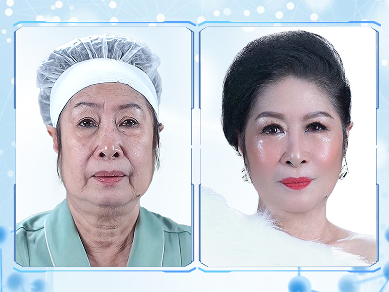 Làn da NSUT Kim Phương trước và sau liệu trình trẻ hóa tại Sejung