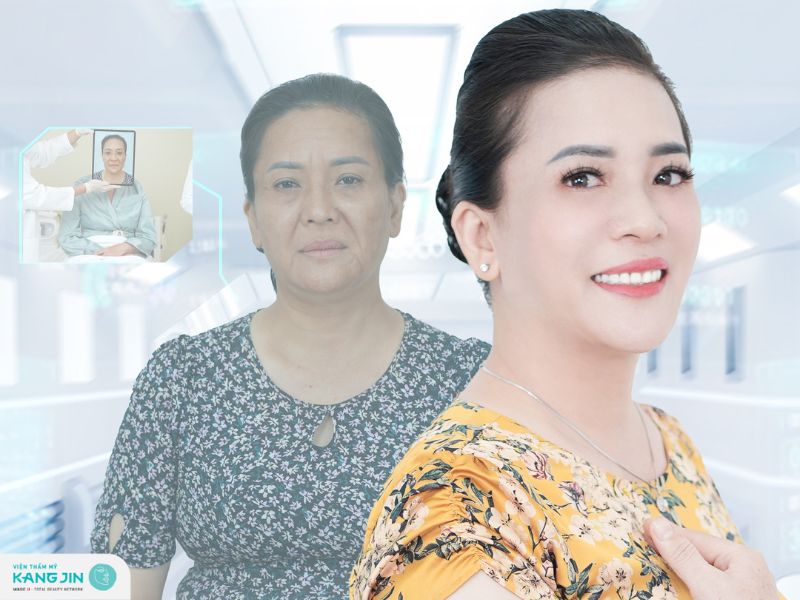 bảng giá căng da mặt chảy xệ