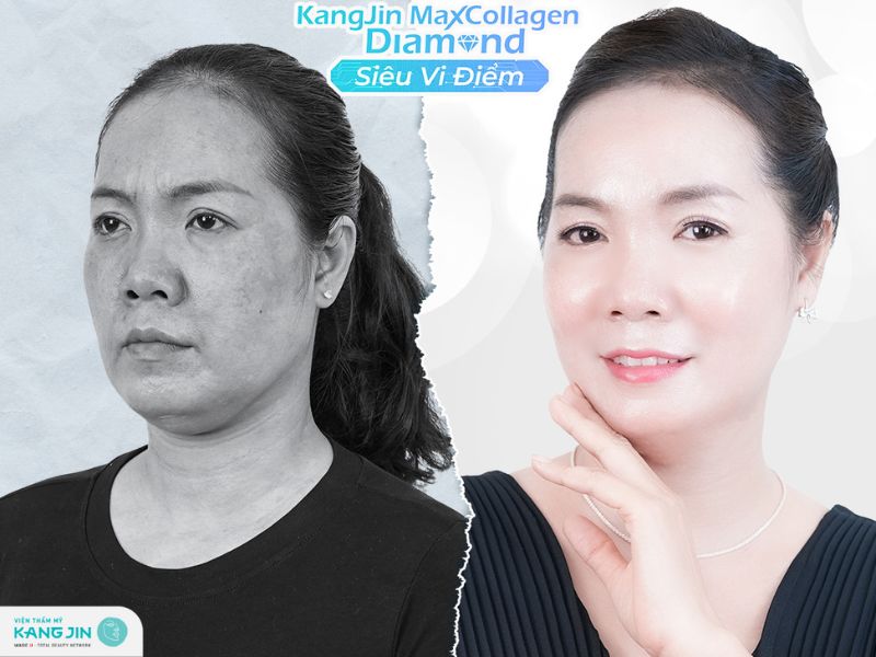 KangJin Maxcollagen Diamond