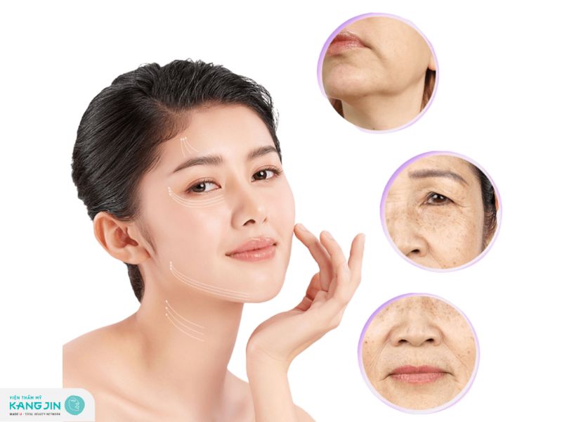 căng chỉ collagen