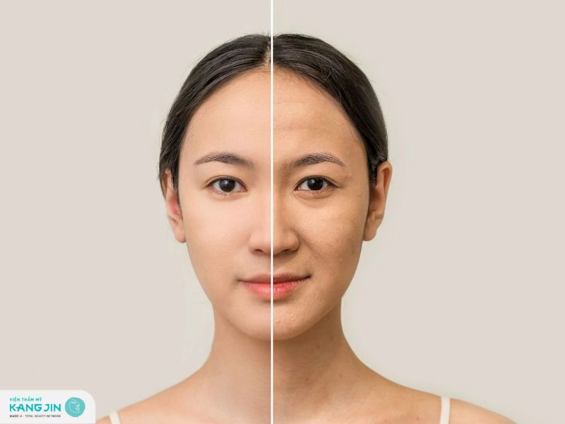 căng chỉ collagen