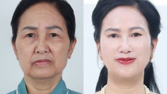 Khám phá chi phí xóa nhăn ấn đường mà bạn không thể bỏ qua