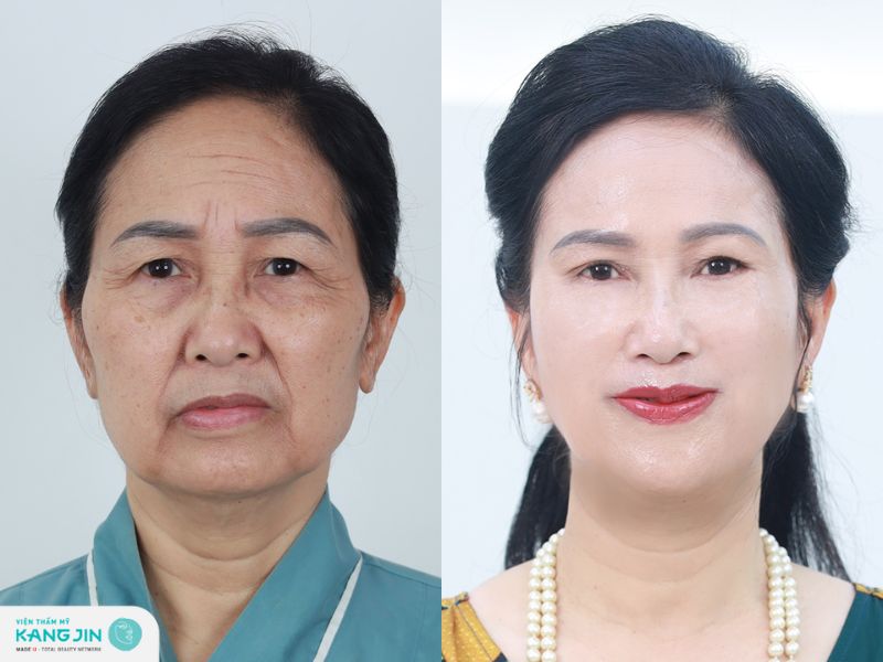 chi phí xóa nhăn ấn đường