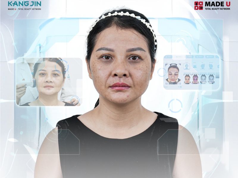 Làn da lão hóa nặng của chị Diễm Châu trước liệu trình