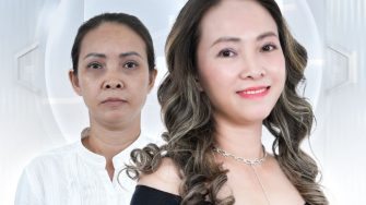 Xoá nhăn có đắt không? Tìm hiểu bảng giá xóa nhăn trán 2025