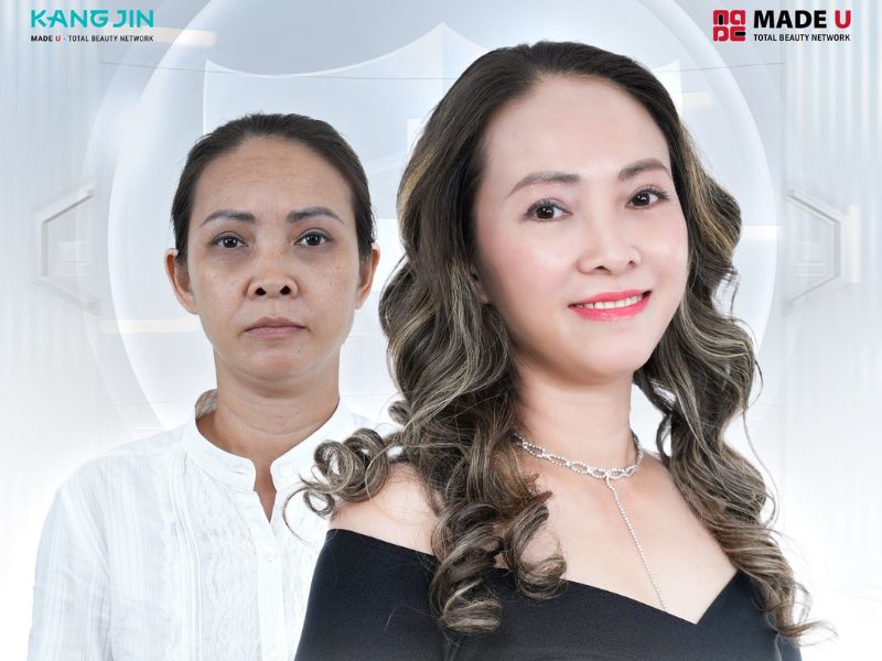 Làm đẹp tiết kiệm với bảng giá xóa nhăn trán năm 2024