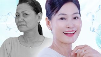 Bất ngờ với 5 giải pháp xóa râu rồng hiệu quả và an toàn nhất