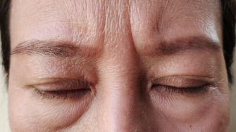 Góc chuyên gia tư vấn: 10 cách xóa nếp nhăn ấn đường hiệu quả