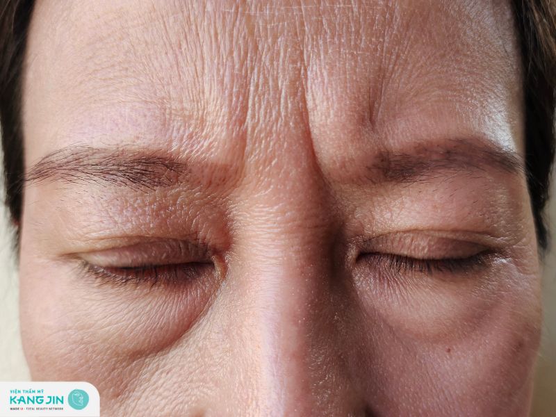 xóa nếp nhăn ấn đường